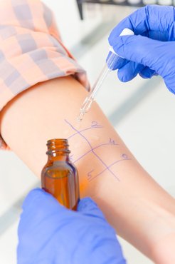 A prick teszt során a bőrre allergéneket csepegtetnek.